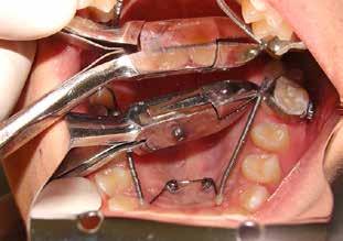 Conclusão O DISTALIZADOR PC foi desenvolvido para que a distalização de molares seja um procedimento simples, promovendo a correção da maloclusão de indivíduos Classe II dentária maxilar uni ou