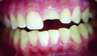Oliveira MMMMB et al A colagem é um procedimento conservador, estético, de execução fácil e rápida, que restaura a morfologia e o contorno da coroa dentária (6).