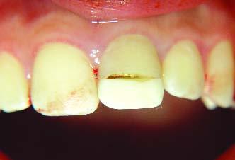 Colagem de um Fragmento Dentário com Fractura Corono Radicular: Relato de Caso Clínico.