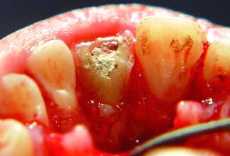 fragmento dentário Figura 4 - Exposição dos limites da fractura Figura 7 - Condicionamento com ácido
