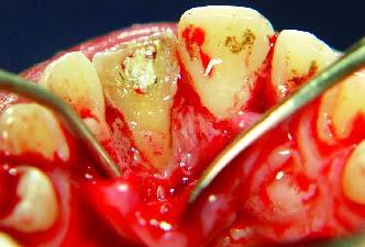 fragmento dentário Figura 8 - Condicionamento com ácido ortofosfórico gel a 37% por 15 s no fragmento