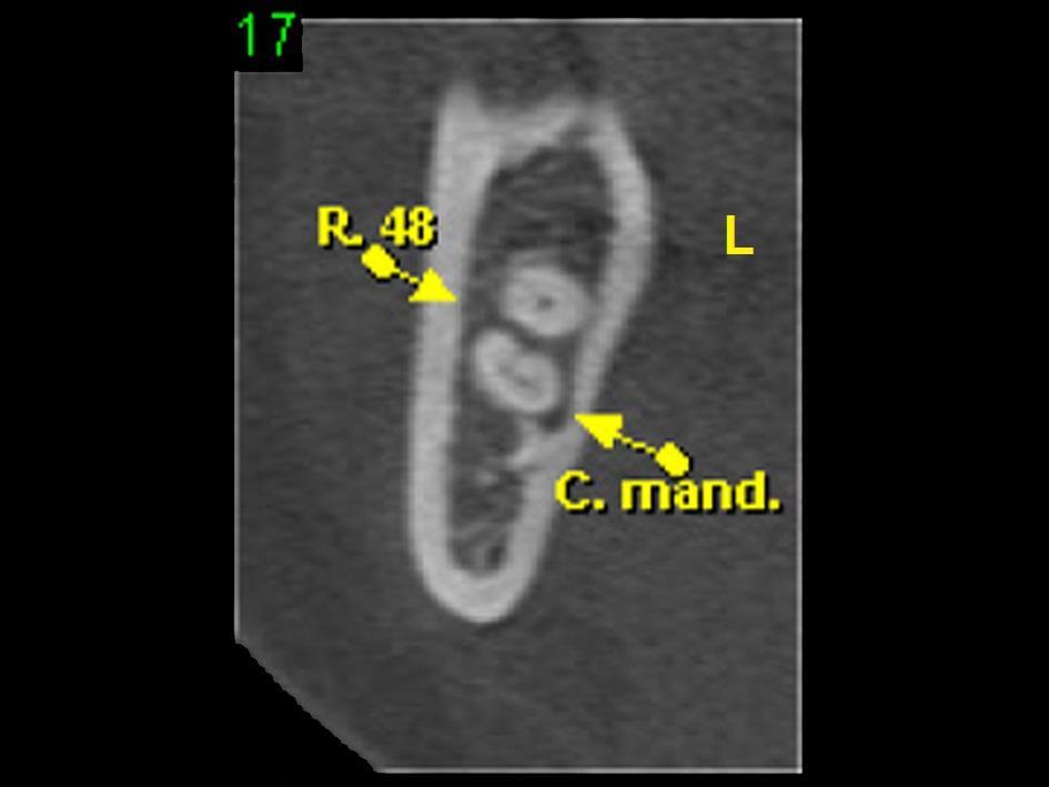 112 Fig. 2 Corte parassagital do dente 48, abaixo da furca, revelando íntimo contato da raiz mesial com o CM, pela face lingual.