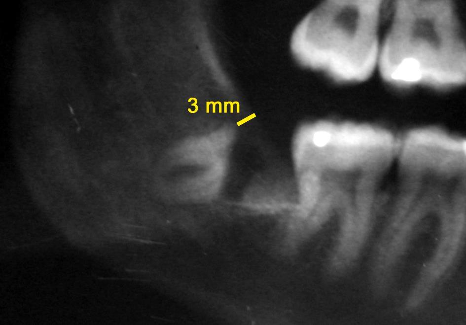 114 Foi realizada radiografia panorâmica pós-operatória imediata (Fig. 6) e de 180 dias após o procedimento (Fig. 7). Fig.