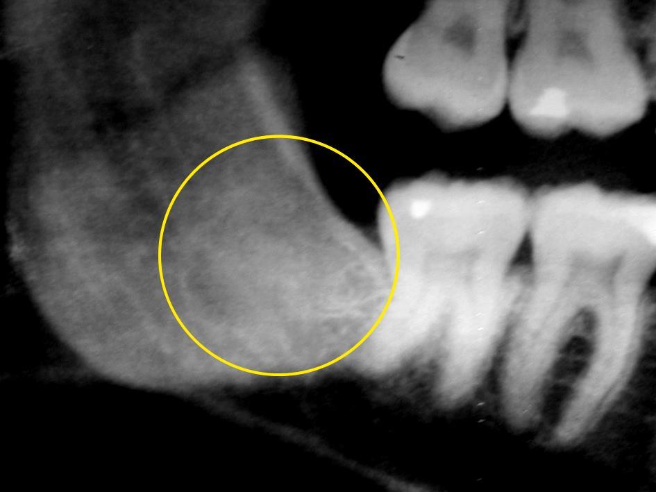 (indicado pela seta amarela) e aspecto normal dos tecidos gengivais na região com leve hiperplasia em direção à região lingual. Fig.