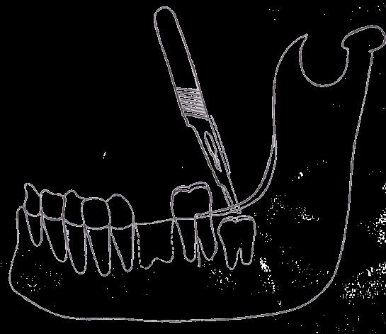 deve ainda ser preparado com uma profundidade superior ao tamanho radicular do dente dador de forma a permitir colocá-lo abaixo do plano oclusal e ausente dos movimentos excursivos da mandíbula para