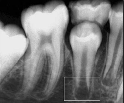Anexo I Autotransplantes de dentes com rizogénese imcompleta Figura A Segundo pré-molar com rizogénese incompleta.