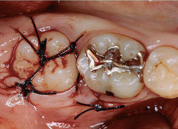 Figura C Terceiro molar com rizogénese incompleta transplantado para a posição do segundo molar.