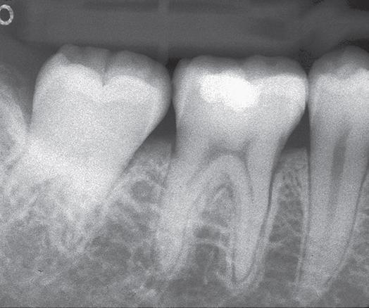 A gengiva circundante é suturada de forma a ficar bem adaptada ao dente (Tsukiboshi M. Autotransplantation of teeth: requirements for predictable success.