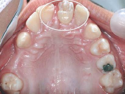 Anexo III Autotransplante de um pré-molar superior para a região do incisivo superior Figura A Autotransplante de um pré-molar superior para a região de incisivo superior perdido por traumatismo com