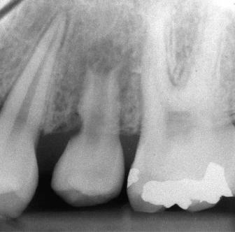 Anexo IV Complicações Figura A Radiografia de follow-up após 2 meses (autotransplante de um pré-molar).