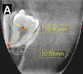 Anexo V Tomografia computadorizada (TC) utilizada no autotransplante Figura A Imagem de tomografia computadorizada de terceiro molar mandibular do 4º quadrante, para averiguação das dimensões (Honda