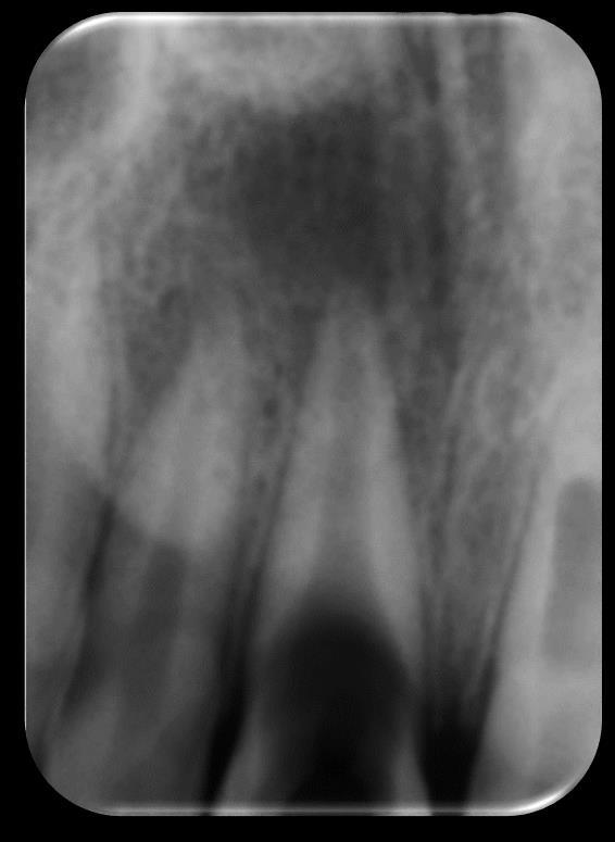 Anexo 2 Caso Clínico - Apexificação com ProRoot MTA do