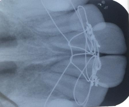 Antes do início das sessões uma radiografia periapical foi obtida e nesta tomada uma medida com rágua milimetrada transparente desde ápice radicular à borda incisal e assim obtido o comprimento