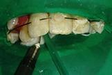 Após 10 semanas verificou-se a ausência de mobilidade excessiva dos dentes e decidiu-se remover a fixação semirrígida.. A B Fig.