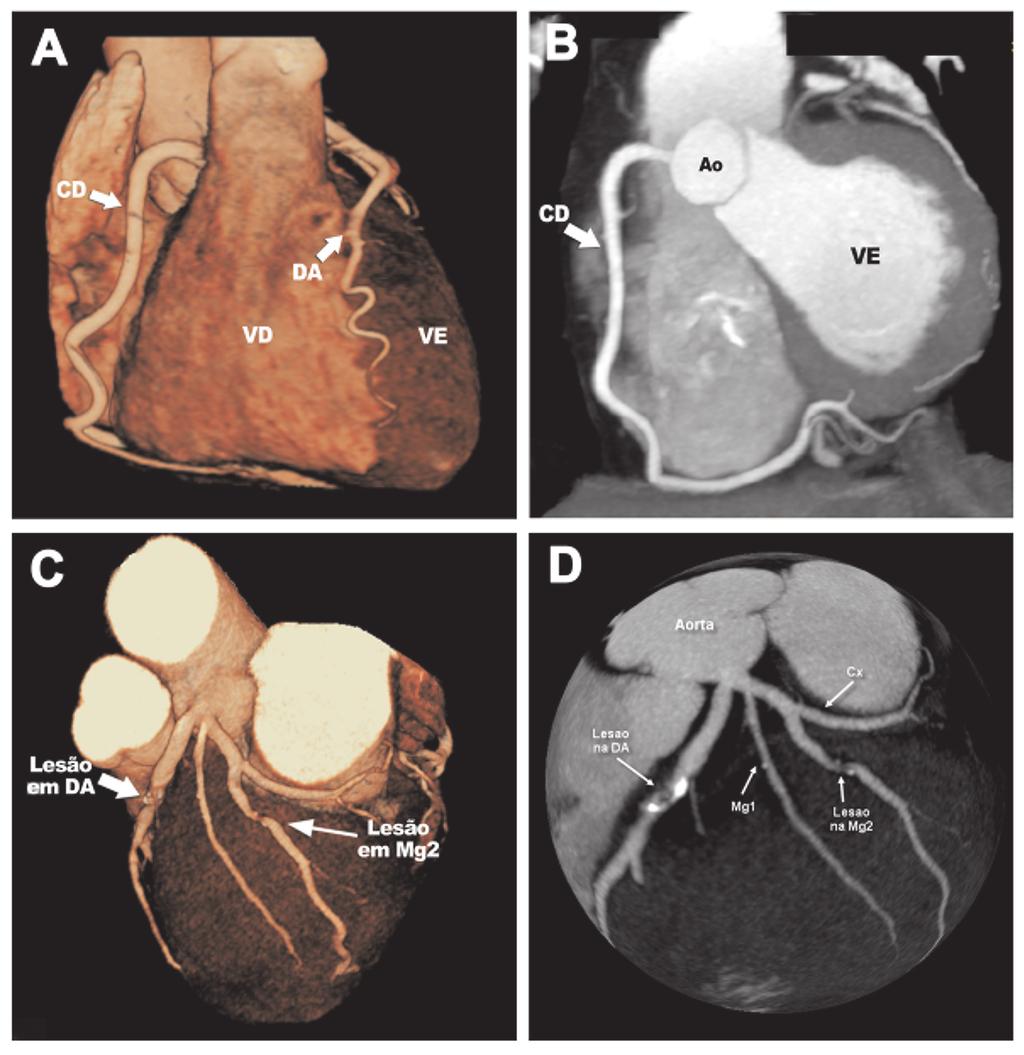 Figura 3 - Imagens ilustrativas de dois pacientes que foram submetidos à angiotomografia coronariana.