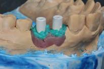 05) e a captura com um dente de estoque e resina Opallis Flow (FGM) para confecção de uma prótese temporária (Fig. 06).
