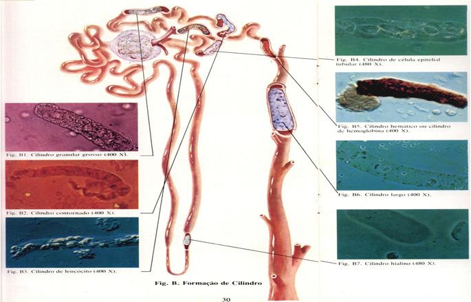 Cilindros Urinários Tipos de Cilindros