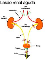 Podem ocorrer alterações hormonais, como a deficiência de eritropoetina e de vitamina D INSUFICIÊNCIA RENAL AGUDA Pode ser Pré renal, Renal ou Pós renal Pré renal: por deficiência na perfusão Renal: