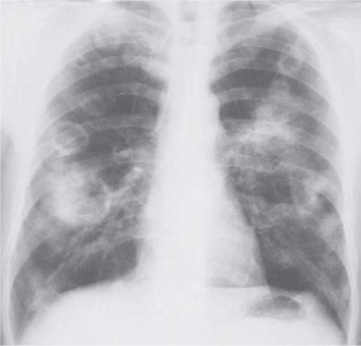 doença. Neste, como em outros estudos, houve nítida predominância do acometimento pulmonar (,10,1,0).