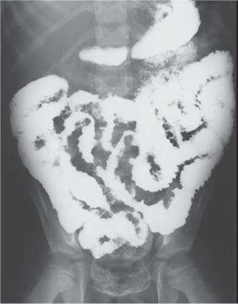 Trad HS et al. Figura. Acometimento intestinal com espessamento e afilamento das alças intestinais. Figura 6. Floculações em alças intestinais. Figura 7.