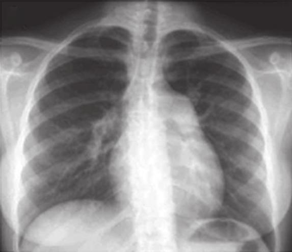 Diagnóstico e tratamento da hipertensão pulmonar: uma atualização 797 Figura 2 - Em a), radiografia de tórax de uma paciente de 30 anos com hipertensão arterial pulmonar idiopática, na qual podemos