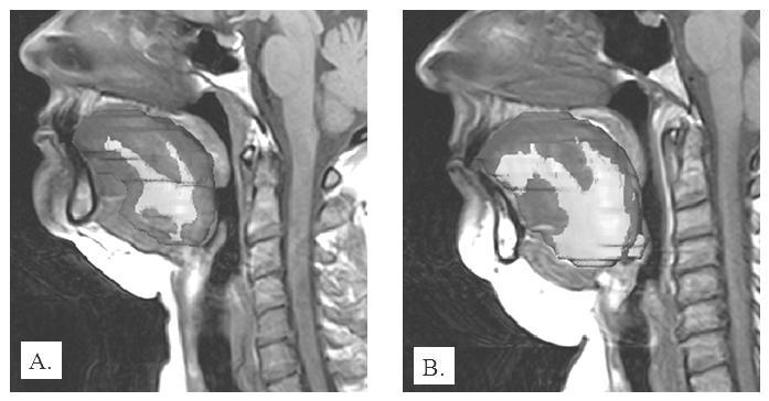 Figura 3. Imagens de ressonância magnética de via aérea. A. sujeito normal. B. sujeito com apneia.