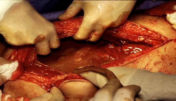 Choque Hipovolêmico R REMEDIAR A CAUSA SUBJACENTE Cirurgia: lavagem, drenagem de abscessos, debridamento