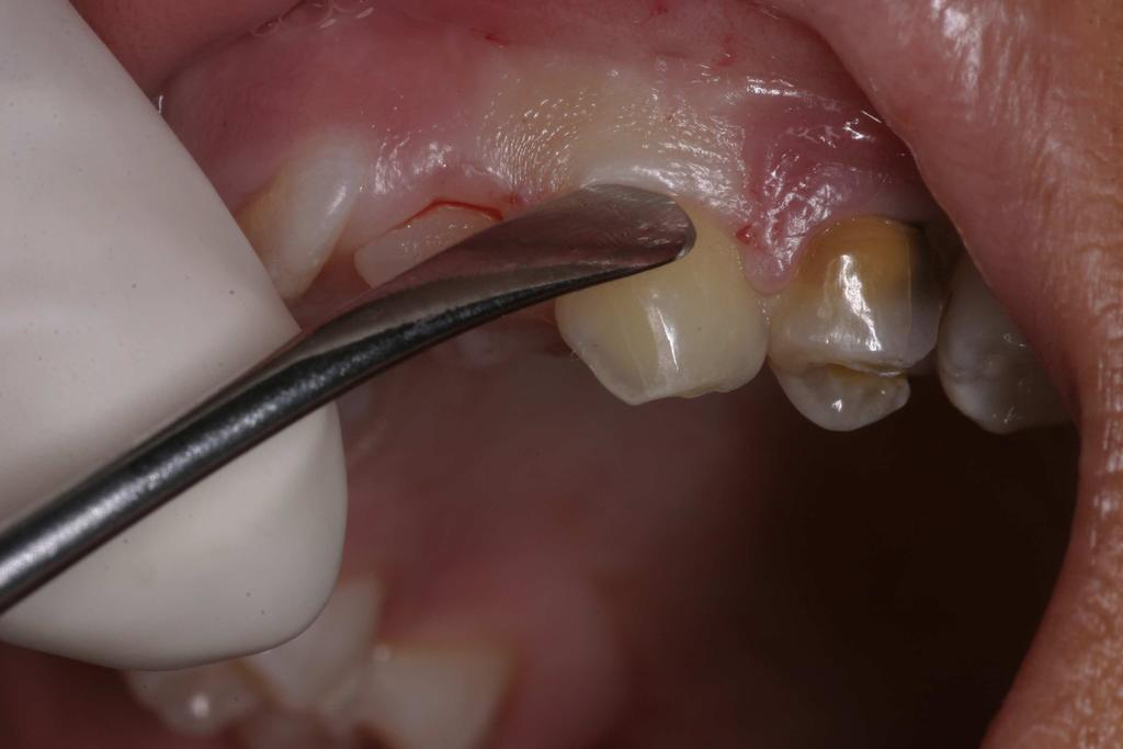 O dente é reposicionado em seu alvéolo por pressão digital, após ter sido lavado com soro fisiológico e seco em gaze estéril. 6.