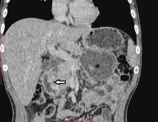 67 Pancreatite de sulco pancreatoduodenal Figura 2. Imagem axial de TC pós-contraste. Figura 3.