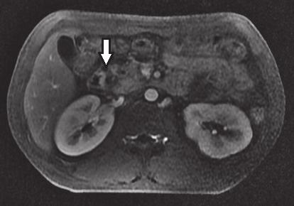 relação ao tecido pancreático. Necrose pancreatica delimitada (*) como achado adicional. Figura 5.