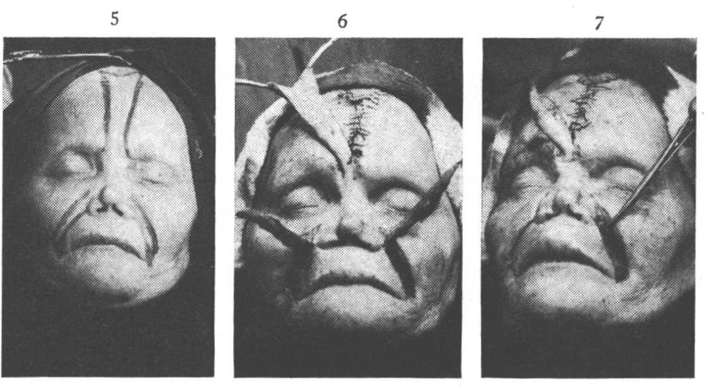 72 REVITA BRASILEIRA DE LEPROLOGIA Figs. 5, 6 e 7 Casos de leprose corn nariz retraído, atrofia do maxilar anterior, e ângulo columelo labial muito superior a 90º, esboçando um perfil côncavo.