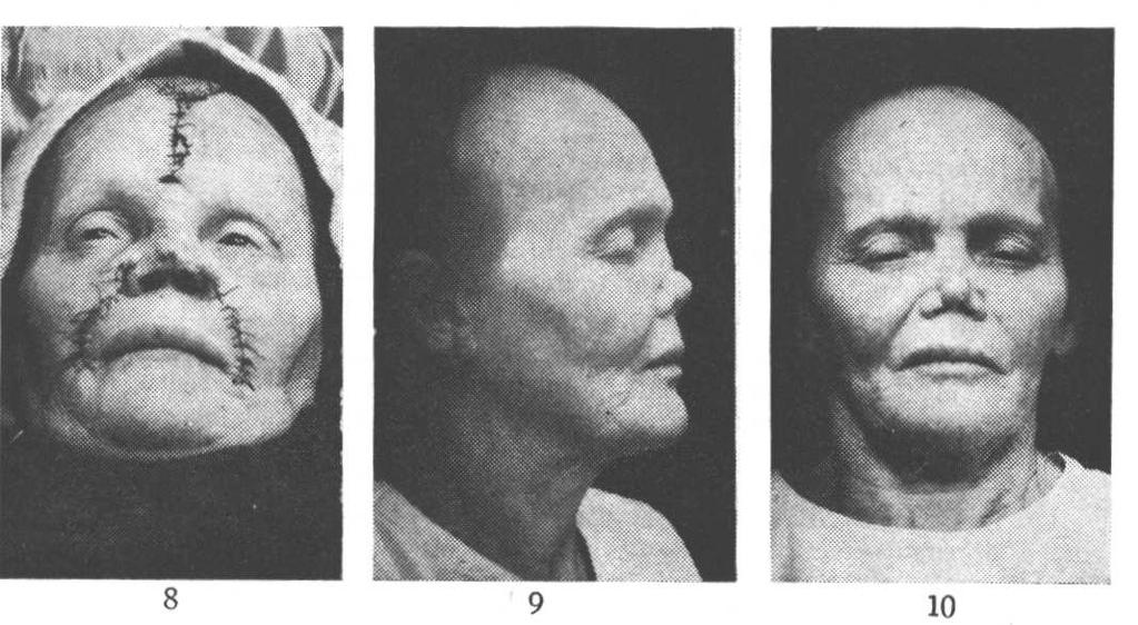 8, 9 e 10 Resultados dois meses após, com correção de contôrno nasal, diminuição notável do ângulo lábio-nasal e normalização do perfil.