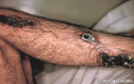 Bacillus anthrax Em geral, apresenta-se como uma infecção na pele que pode começar com