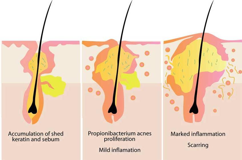 Propionibacterium acnes Presença de nódulos ou cistos, que são