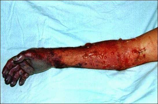 Gasosa(Mionecrose) Infecção grave, atinge derme, tecido subcutâneo