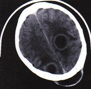 Ocorre a formação de lesão com pseudomembrana, ulceração e necrose.