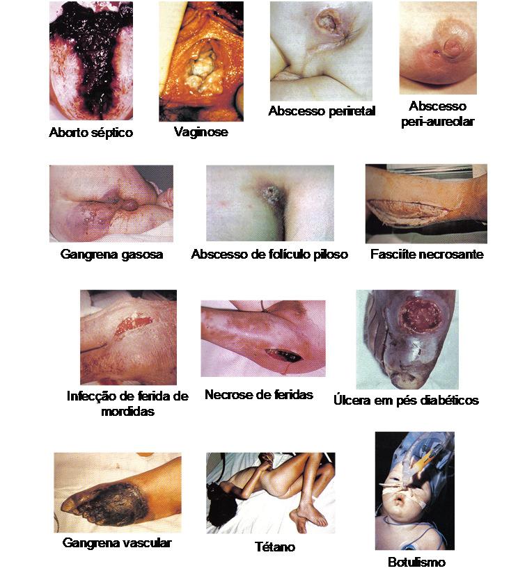 Abscessos intra-abdominais e peritonites Anaeróbios - Peptostreptococcus, Bacteroides, Fusobacterium, Clostridium.