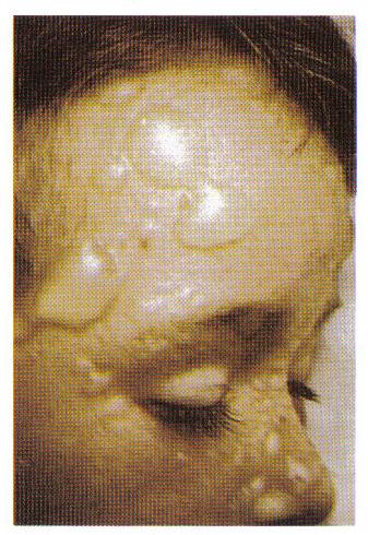 aureus na nasofaringe Podem ser transmitidos entre os hospedeiros por contato direto ou através de fômites; Importância na Odontologia: infecções oportunistas e nosocomiais - biossegurança