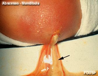 S. aureus Doenças cutâneas causadas pela invasão e destruição tecidual (piogênicas) Foliculite, terçol, furúnculo, infecções em feridas Infecção dos folículos pilosos, com formação de pus embaixo da