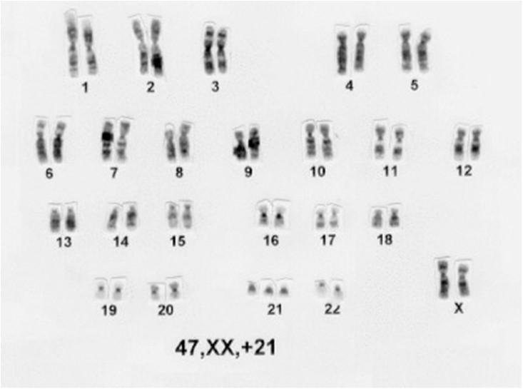 Trissomia - um cromossomo extra 37 Monossomia - um membro do