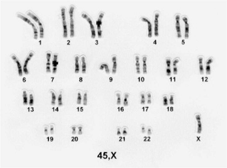 A monossomia de um cromossomo inteiro é quase sempre letal, à