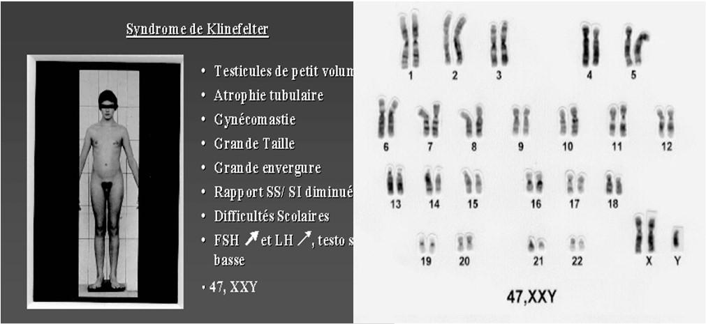SÍNDROME DE KLINEFELTER (47, XXY) Os pacientes são altos e magros, com membros inferiores relativamente longos. Após a puberdade os sinais de hipogonadismo se tornam óbvios.