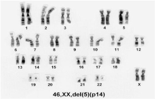 SÍNDROME DO MIADO DO GATO (5p-) Deleção do braço curto do cromossomo 5 Choro típico -