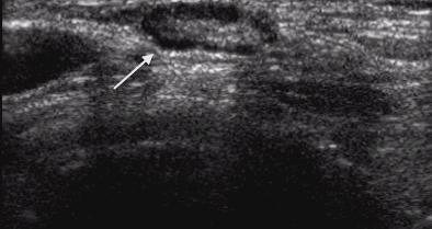 Ultrasound image of normal axillary lymph node Ultrasound image of