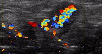 Ultrasound image of Doppler flow in abnormal axillary lymph node Ultrasound