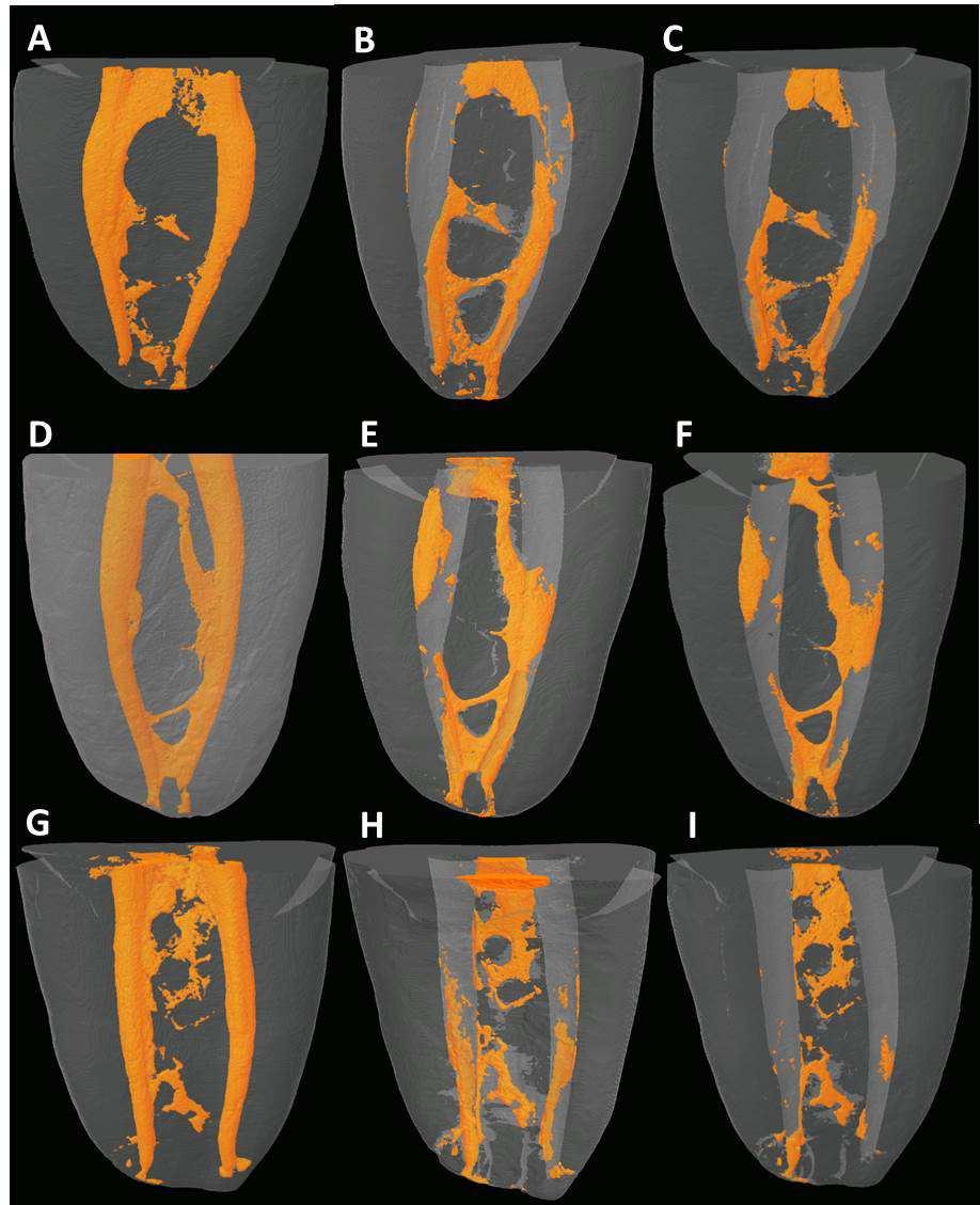 27 Figura 1. Imagens de Reconstrução de Amostras pelo Microtomógrafo. Grupo Hedströem (A-C), ProTaper (D-F) e Reciproc (G-I).