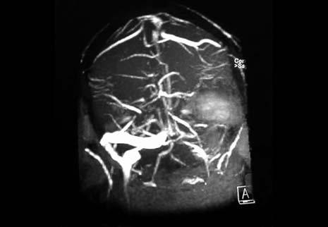 ..confirma o dx de trombose dos seios sigmoideu e transverso à esquerda, com enfarte venoso associado com transformação hemorrágica recente... Figura 5. Angio RMN-CE (25-05-2003)-.