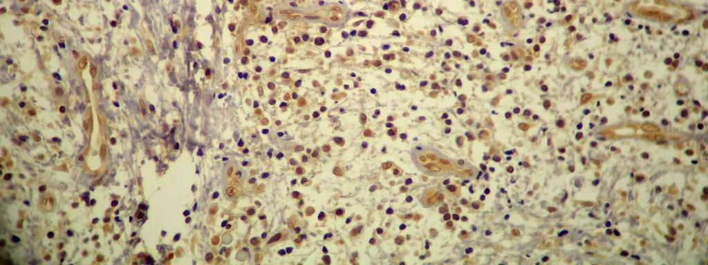 MMP-9 nas células endoteliais dos vasos