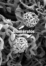 Conceito: Glomerulonefrite Aguda É uma doença inflamatória que afeta os glomérulos renais de ambos os rins.