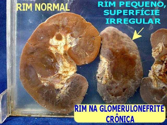 Glomerulonefrite Crônica Conceito: Destruição progressiva do tecido renal, podendo se prolongar por